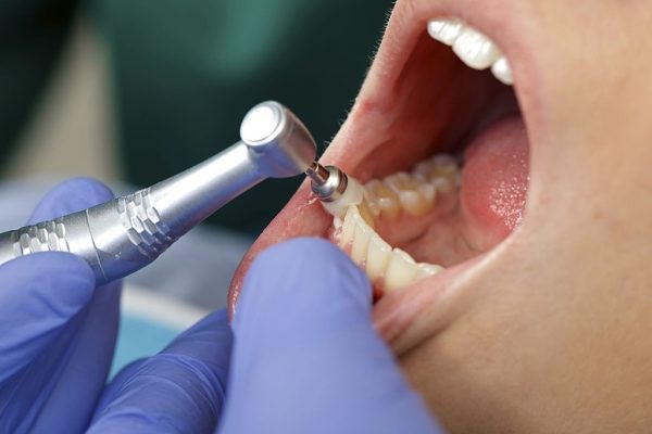 Close up of a professional dental brushing at the clinic
