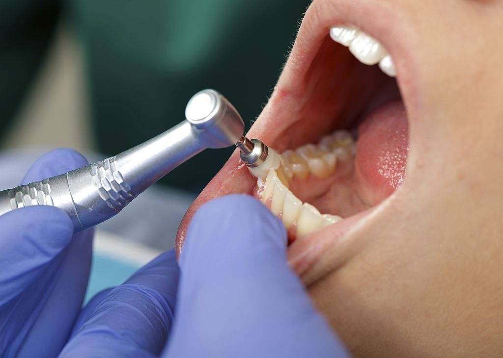 Close up of a professional dental brushing at the clinic